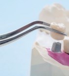 מחסור בשיניים - תמונת המחשה